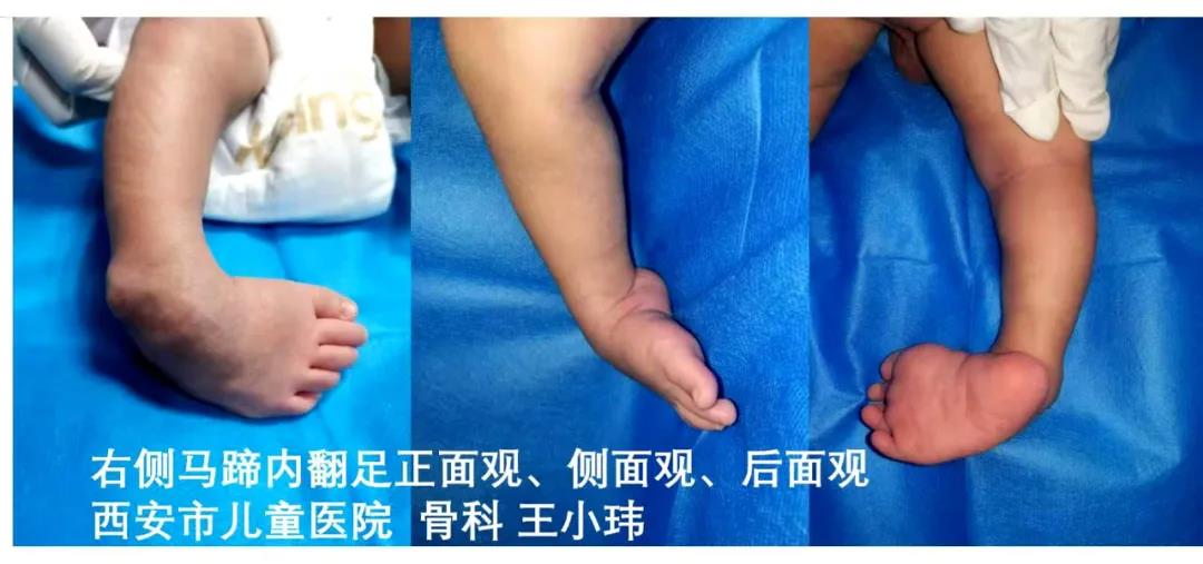 健康宣教孕期发现胎儿马蹄足是留还是流