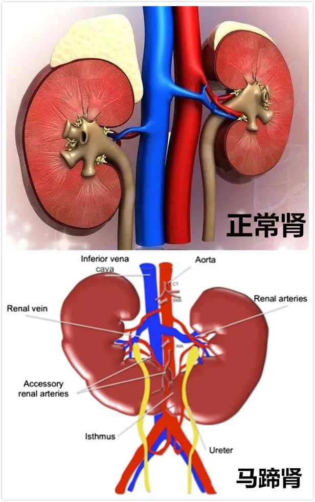 与正常肾脏形态不同,马蹄肾患者的两侧肾脏是相互靠近融合在一起的,绝