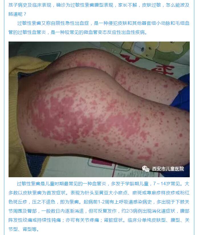 儿童过敏性紫癜要做肠道超声检查家长需知道