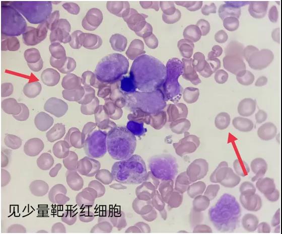 静脉血涂片图片